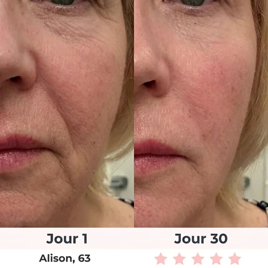 Lumilift | Appareil de lifting visage & cou